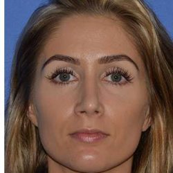 Rhinoplasty Before & After Patient #6763