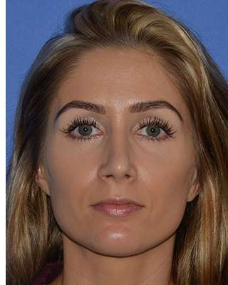 Rhinoplasty Before & After Patient #6763