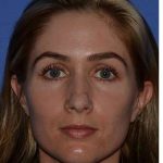 Rhinoplasty Before & After Patient #6763