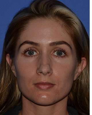 Rhinoplasty Before & After Patient #6763