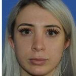 Revision Rhinoplasty Before & After Patient #6760