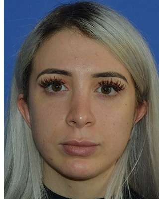 Revision Rhinoplasty Before & After Patient #6760