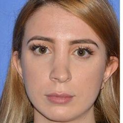 Revision Rhinoplasty Before & After Patient #6760