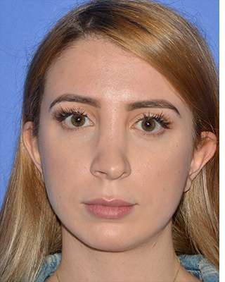 Revision Rhinoplasty Before & After Patient #6760