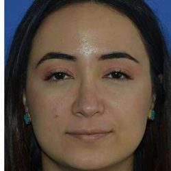 Ethnic Rhinoplasty Before & After Patient #6757