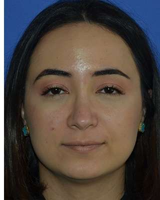 Ethnic Rhinoplasty Before & After Patient #6757