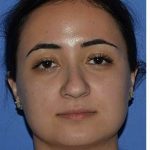 Ethnic Rhinoplasty Before & After Patient #6757