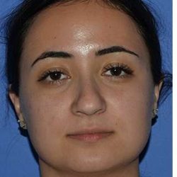 Ethnic Rhinoplasty Before & After Patient #6757