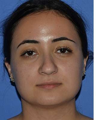 Ethnic Rhinoplasty Before & After Patient #6757