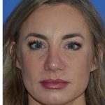 Revision Rhinoplasty Before & After Patient #6754