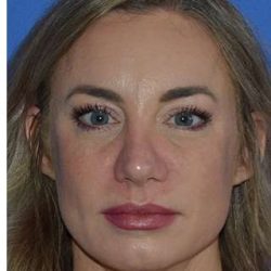 Revision Rhinoplasty Before & After Patient #6754