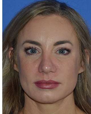 Revision Rhinoplasty Before & After Patient #6754