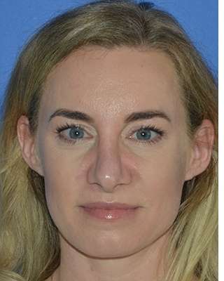 Revision Rhinoplasty Before & After Patient #6754