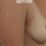 Breast Augmentation Before & After Patient #9101