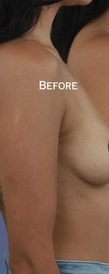 Breast Augmentation Before & After Patient #9101