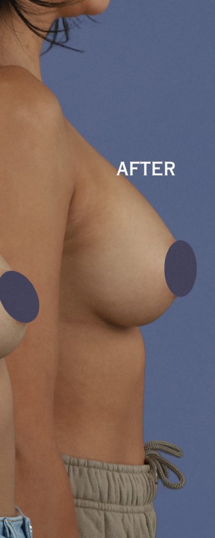 Breast Augmentation Before & After Patient #9101