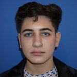 Rhinoplasty Before & After Patient #9989