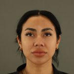 Rhinoplasty Before & After Patient #9990