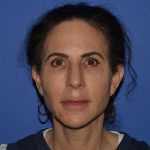 Regenelift™ Facelift Before & After Patient #9993