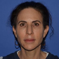Regenelift™ Facelift Before & After Patient #9993