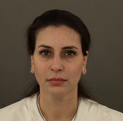 Rhinoplasty Before & After Patient #9994