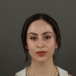 Rhinoplasty Before & After Patient #9783