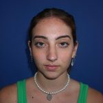 Rhinoplasty Before & After Patient #9996