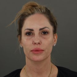Rhinoplasty Before & After Patient #9997