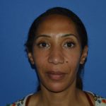Regenelift™ Facelift Before & After Patient #9998