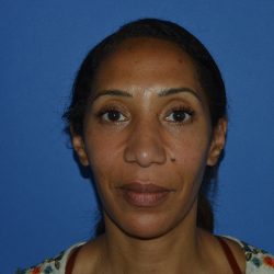 Regenelift™ Facelift Before & After Patient #9998