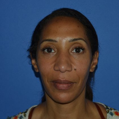 Regenelift™ Facelift Before & After Patient #9998