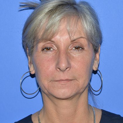 Regenelift&trade; Facelift Before & After Patient #9786