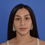 Rhinoplasty Before & After Patient #9999