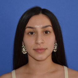 Rhinoplasty Before & After Patient #9999