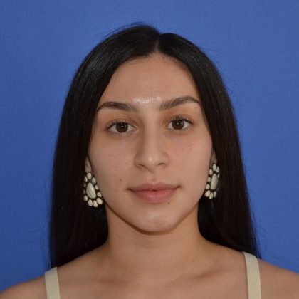 Rhinoplasty Before & After Patient #9999