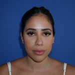 Browlift Before & After Patient #10001