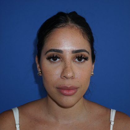 Browlift Before & After Patient #10001