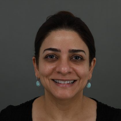 Regenelift&trade; Facelift Before & After Patient #9788