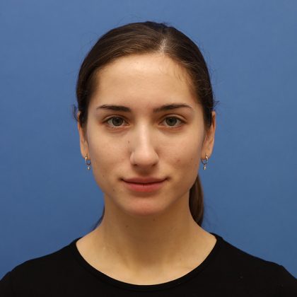 Rhinoplasty Before & After Patient #9790