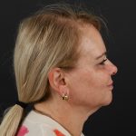 Regenelift™ Facelift Before & After Patient #9793