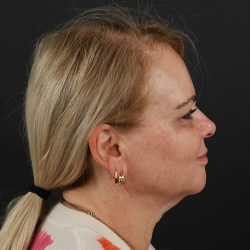 Regenelift™ Facelift Before & After Patient #9793
