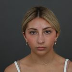 Rhinoplasty Before & After Patient #9987