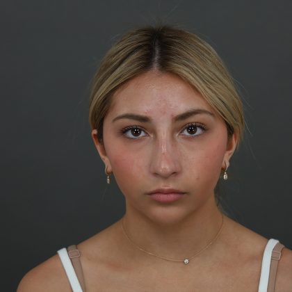 Rhinoplasty Before & After Patient #9987