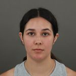 Rhinoplasty Before & After Patient #9988