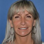 Regenelift™ Facelift Before & After Patient #9786