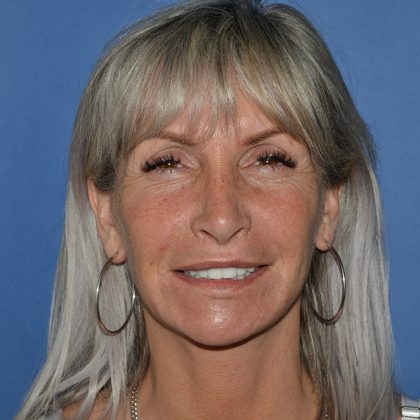 Regenelift&trade; Facelift Before & After Patient #9786