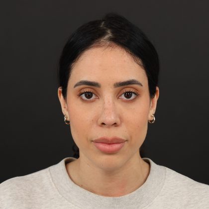Browlift Before & After Patient #10001