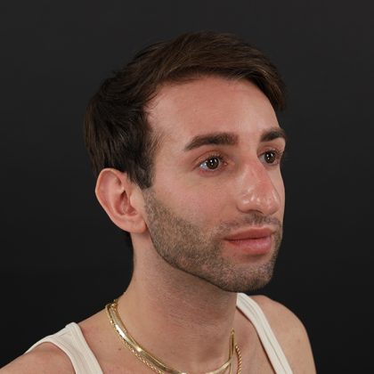 Rhinoplasty Before & After Patient #9785
