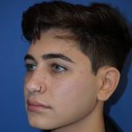 Rhinoplasty Before & After Patient #9989