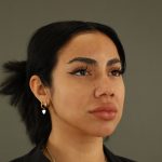 Rhinoplasty Before & After Patient #9990